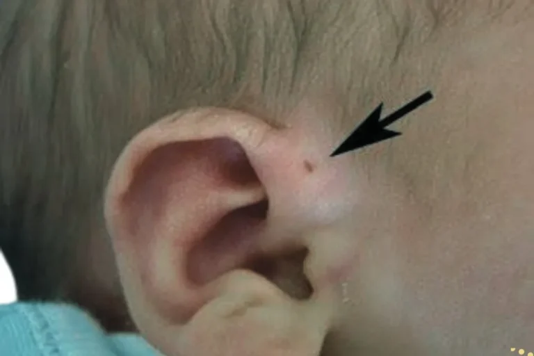 what-is-the-spiritual-meaning-of-hole-in-the-ear-or-preauricular-sinus